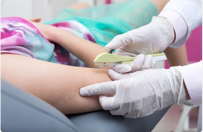 Enfermeiros capacitados podem inserir implante contraceptivo no SUS